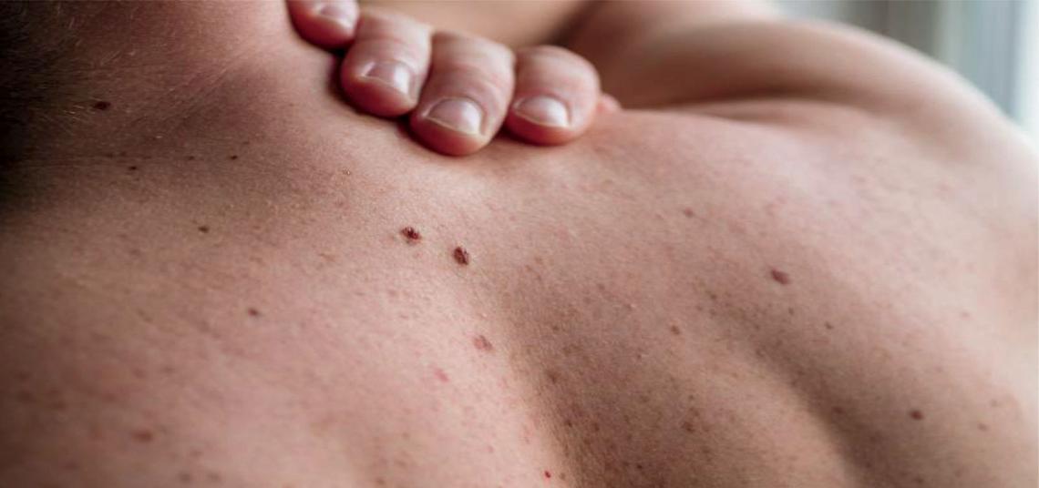 Nevo o melanoma? Una diagnosi precoce ti salva la vita