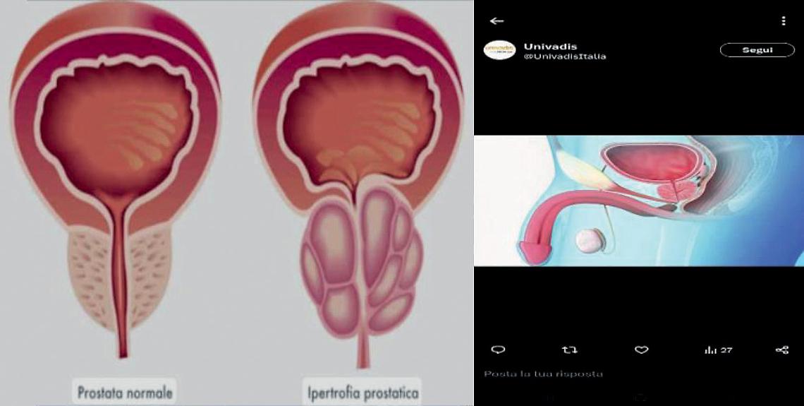 Ipertrofia prostatica benigna
