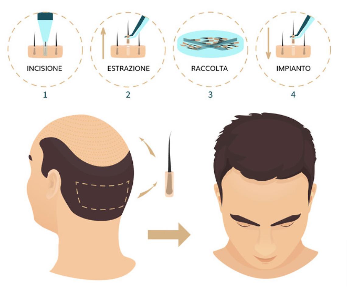 Autotrapianto di capelli