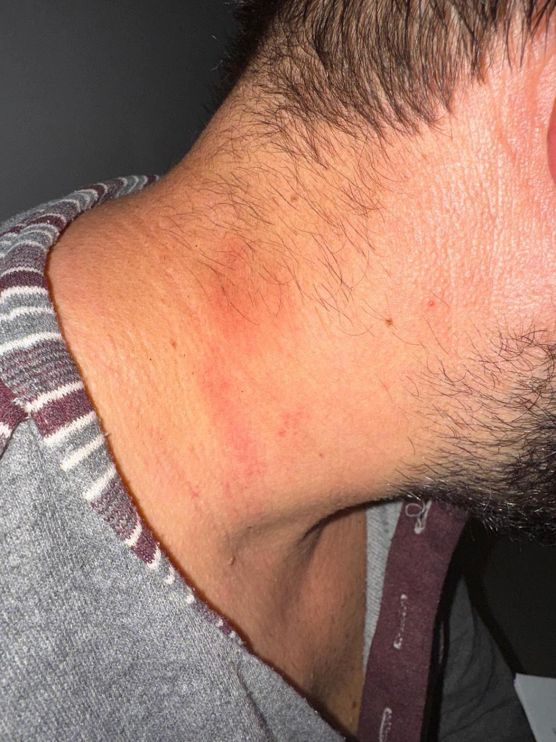 Una delle ferite riportate dall'agente di Polizia penitenziaria a Trani - foto Cosp Bari