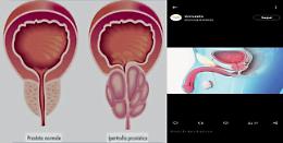 Ipertrofia prostatica benigna: cause e sintomi