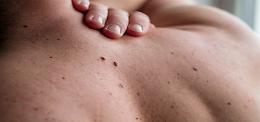 Nevo o melanoma? Una diagnosi precoce ti salva la vita