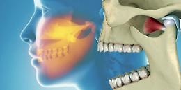 Il botulino e l’acido ialuronico come rimedi per il dolore facciale