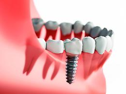 La chirurgia computer-guidata in implantologia dentale: futuro già presente per sorrisi perfetti
