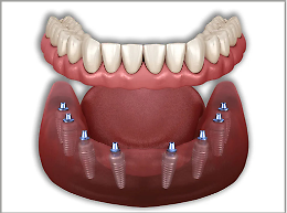 Soluzioni innovative per l’implantologia dentale in caso di atroﬁa ossea mascellare