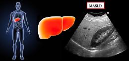 Fegato grasso (steatosi epatica): doppio rischio per fegato e sistema cardio-circolatorio