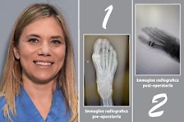 Alluce rigido: soluzioni innovative nelle fasi moderate/avanzate