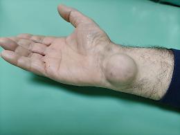 Rimosso tumore all&rsquo;avambraccio senza danni al nervo: intervento ad alta precisione al Di Venere. Le foto