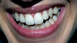Il bruxismo dentale: cosa si sa oggi e come curarlo
