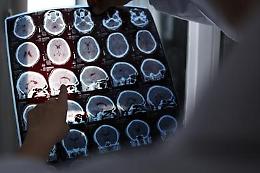 Una speranza per l'alzheimer, oggi il convegno
