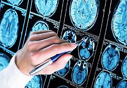 Alzheimer, 300mila euro a 6 scienziati per diagnosi precoce e prevenzione