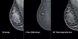 Mammografia 'intelligente' al San Camillo di Roma, aiuter&agrave; gli specialisti nelle diagnosi