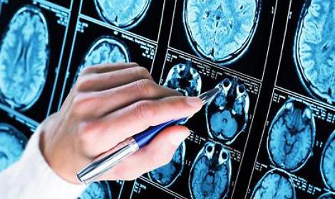 Alzheimer, 300mila euro a 6 scienziati per diagnosi precoce e prevenzione